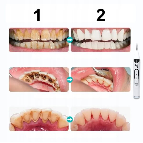 SKALER DENTYSTYCZNY QURE DO ZĘBÓW - obrazek 8